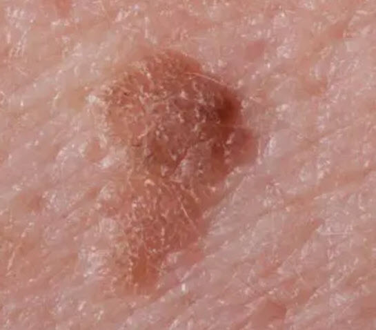 brown spots