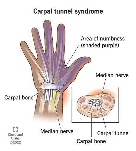 carpal-tunnel-syndrome
